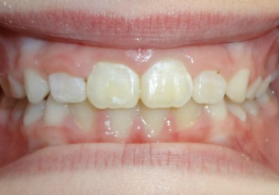 Phase 1 With Expander