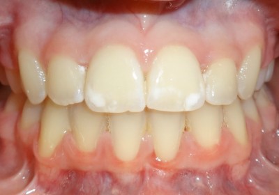 Metal Braces with Extractions