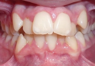 Metal Braces with Extractions
